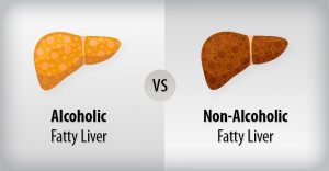 Alcoholic Vs Non-Alcoholic Fatty Liver Disease